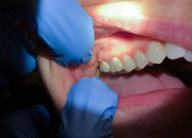 Best Knocked-Out Tooth (Avulsed Tooth) Treatment in Milan, NM
